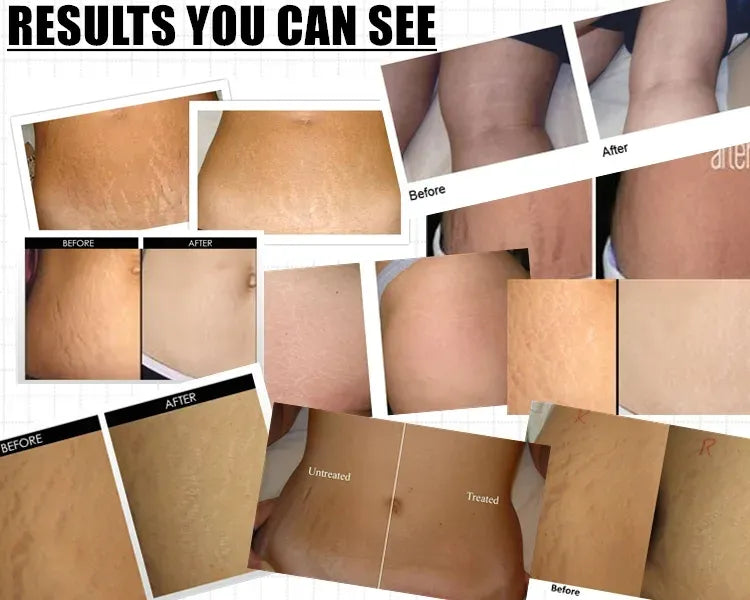 Markaway Stretch Mark Serum – Herbal Solution for Smooth Skin