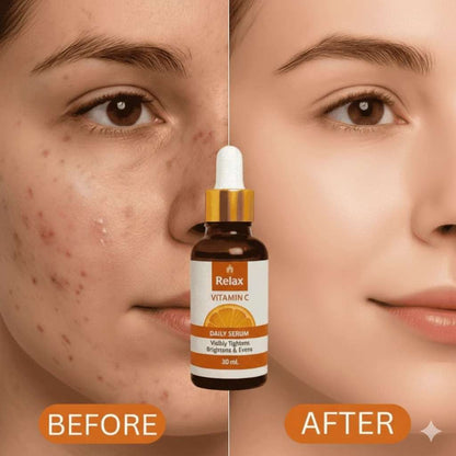 Before and after comparison of a face with acne treatment serum, featuring the Relax Vitamin C serum bottle.