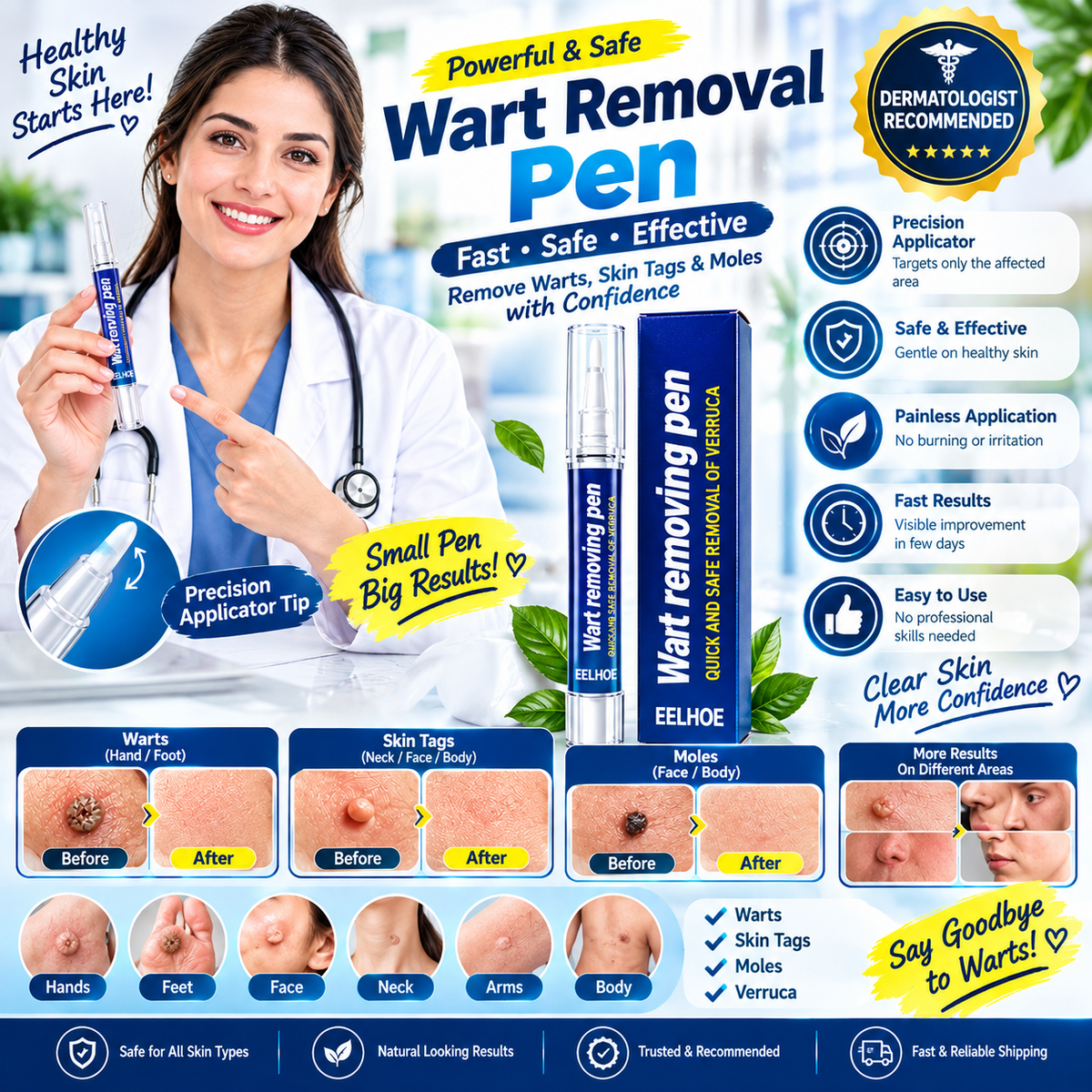 Wart Remover Pen – Easy Wart Removal Treatment for Hands, Feet & Skin